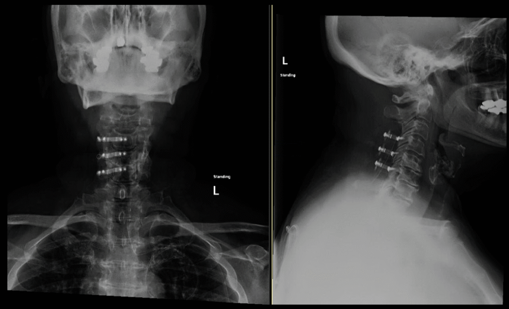 Laminoplasty 1024x623