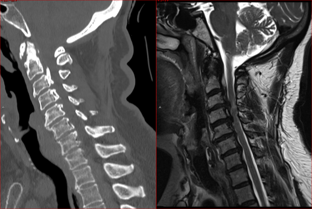 Cervical Myelopathy 1024x686