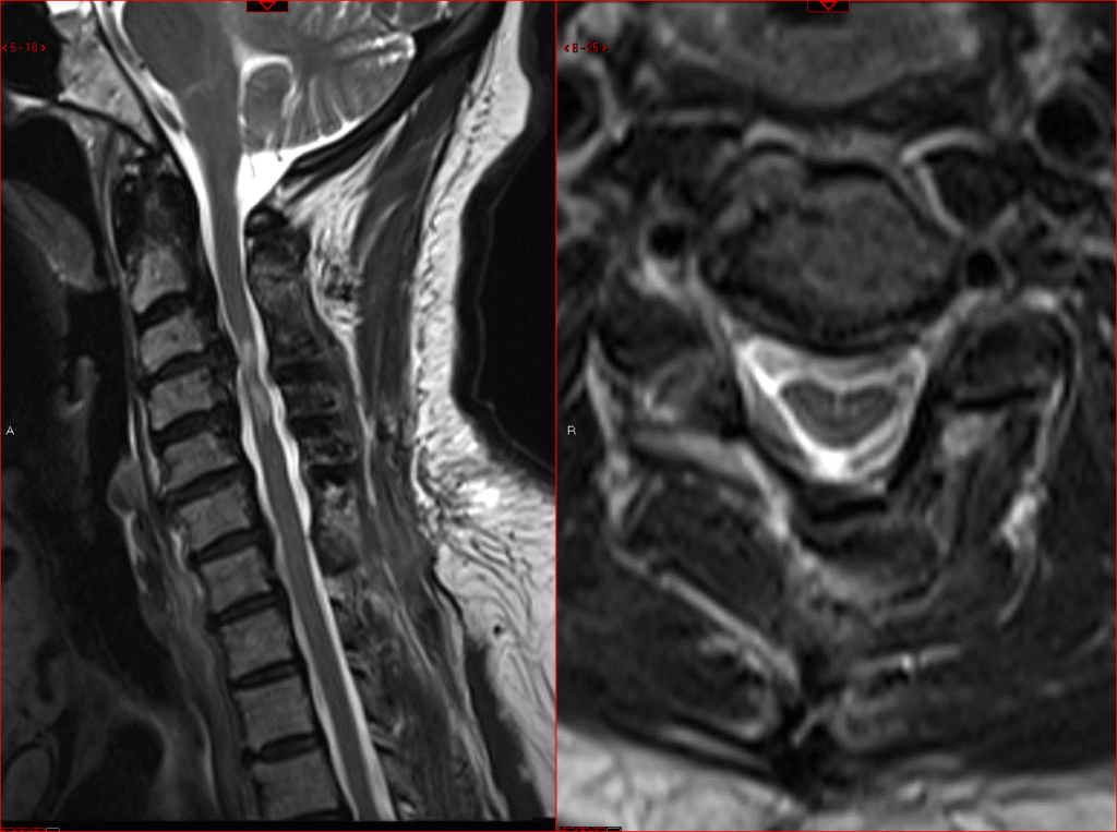 After Laminoplasty 1024x763