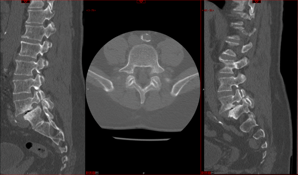 L5 S1 Spondy CT 1024x600