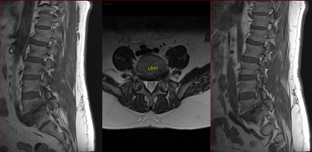 L5 S1 Spondy MRI 2 1024x501
