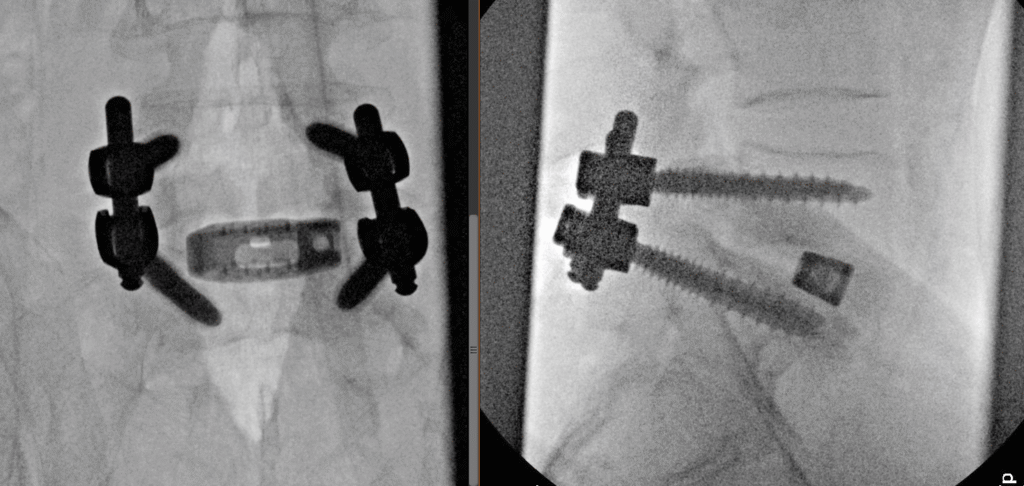 L5 S1 Spondy Intraop 1024x486