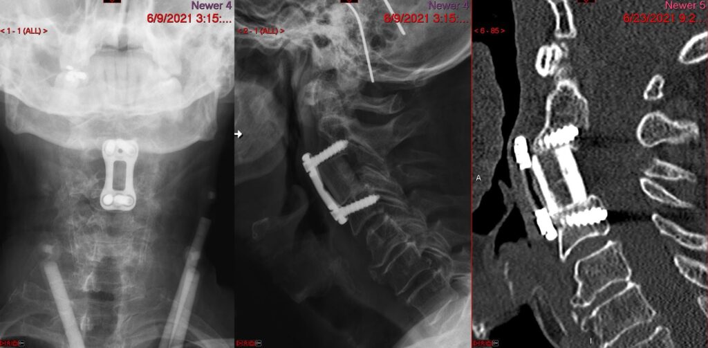 ACCF Postop 1024x503