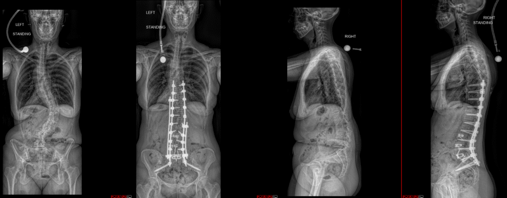 ALIF And T10 Pelvis 1024x400