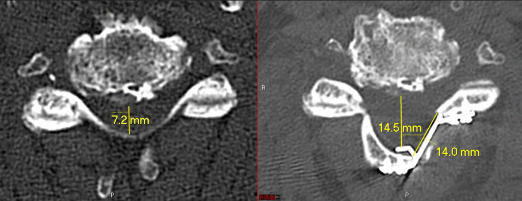 laminoplasty increased size