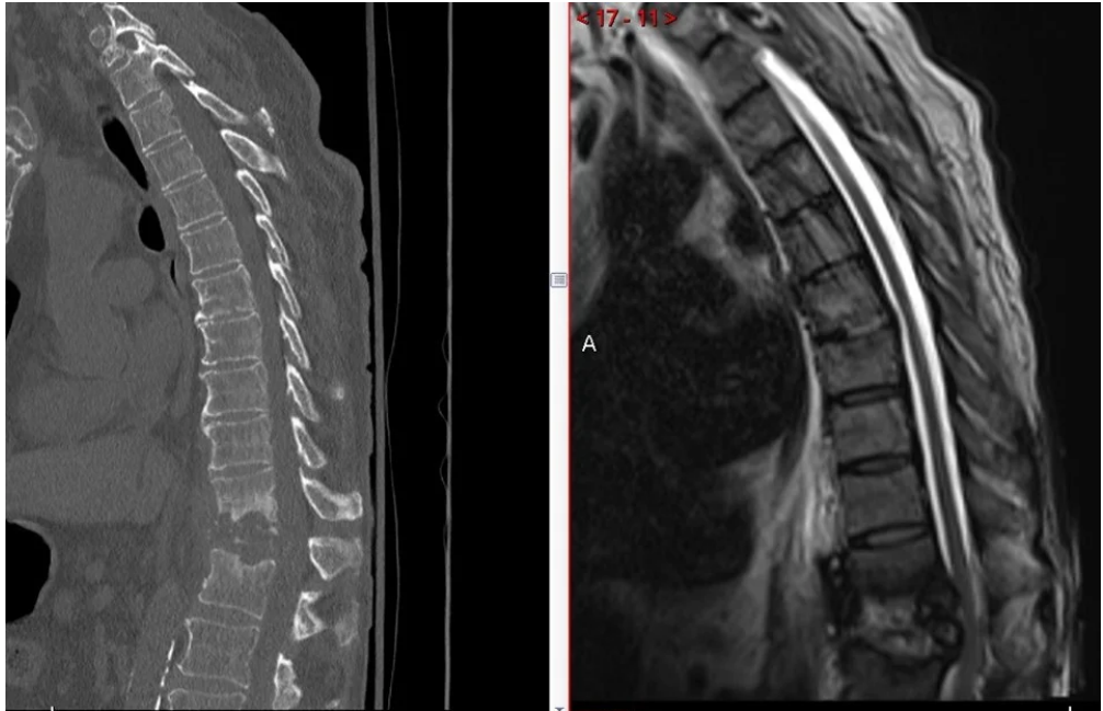 thoracic corpectomy 1
