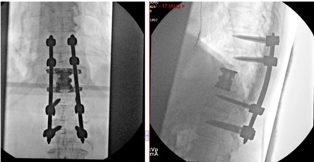 thoracic corpectomy 2