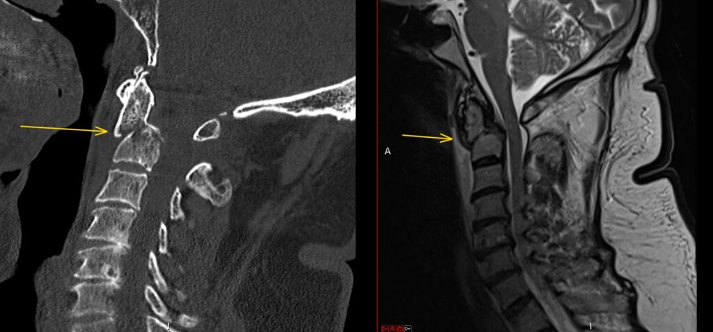 c2 fracture ct mri